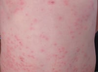 Drop-in for your MMR vaccine