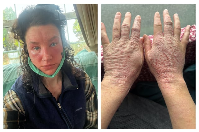 Pembrokeshire woman's horror story reaction to skin cream