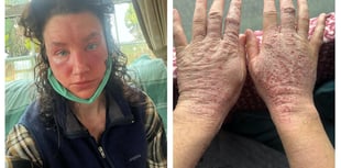 Pembrokeshire woman's horror story reaction to skin cream