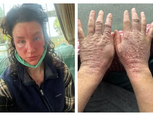 Pembrokeshire woman's horror story reaction to skin cream