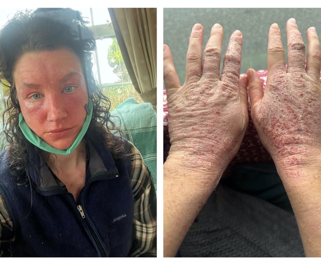 Pembrokeshire woman's horror story reaction to skin cream