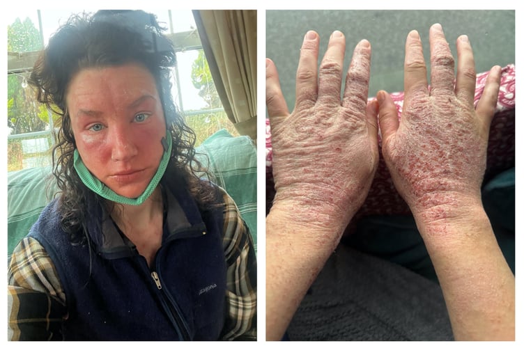Francesca Tebbutt from Clunderwen shares her harrowing experience with severe skin reactions after being diagnosed with Topical Steroid Withdrawal (TSW), seeking support and relief through CAP Therapy.
