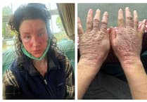 Pembrokeshire woman's skin 'on fire' after cream reaction: TSW Diagnosis