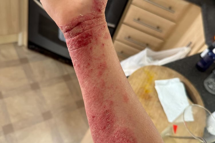A woman who was prescribed topical steroid creams says withdrawal symptoms controlled her life and put her "through hell." Francesca Tebbutt, 33, first noticed itchy, red marks on her arm in 2023 - and sought medical advice when they didn't seem to go away. Her GP believed she was suffering from a psoriasis or eczema breakout, and prescribed her topical steroid creams, to be applied to the area for a couple of weeks at a time. The breakout disappeared quickly - but returned and spread, only for her to be prescribed stronger steroid creams.