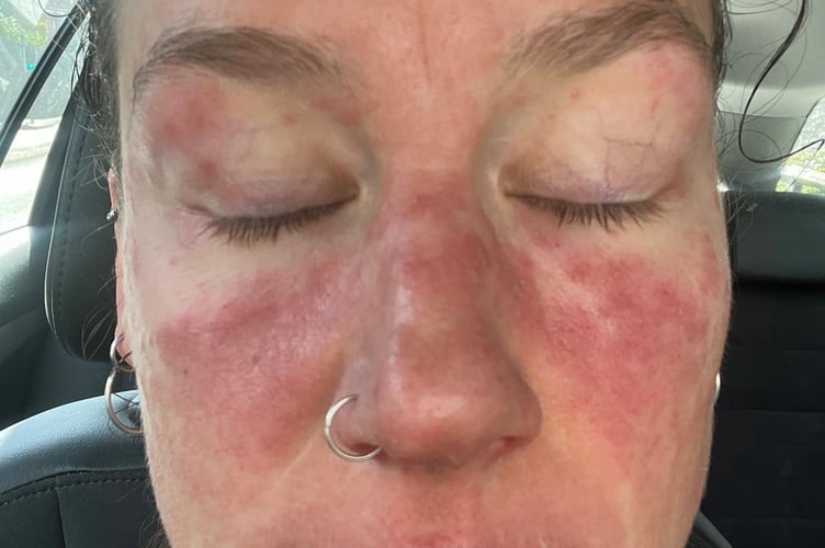 A woman who was prescribed topical steroid creams says withdrawal symptoms controlled her life and put her "through hell." Francesca Tebbutt, 33, first noticed itchy, red marks on her arm in 2023 - and sought medical advice when they didn't seem to go away. Her GP believed she was suffering from a psoriasis or eczema breakout, and prescribed her topical steroid creams, to be applied to the area for a couple of weeks at a time. The breakout disappeared quickly - but returned and spread, only for her to be prescribed stronger steroid creams.