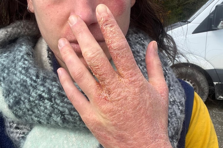 A woman who was prescribed topical steroid creams says withdrawal symptoms controlled her life and put her "through hell." Francesca Tebbutt, 33, first noticed itchy, red marks on her arm in 2023 - and sought medical advice when they didn't seem to go away. Her GP believed she was suffering from a psoriasis or eczema breakout, and prescribed her topical steroid creams, to be applied to the area for a couple of weeks at a time. The breakout disappeared quickly - but returned and spread, only for her to be prescribed stronger steroid creams.